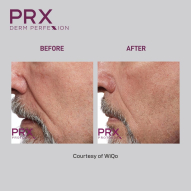 Before and After Photo 3 - PRX